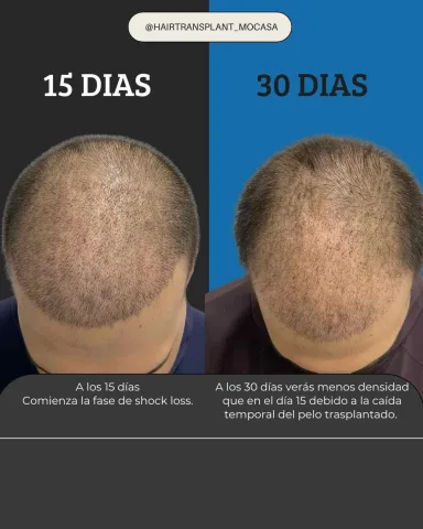 Dias Dias hair transplant result in Miami