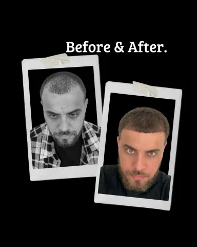 Hair transplant result in Miami