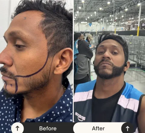 Beard Transplant Result hair transplant result in Miami