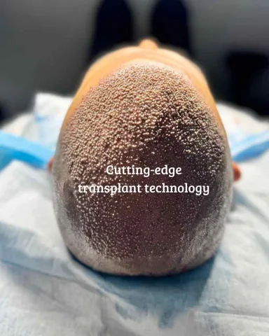 Hair Transplant hair transplant result in Miami