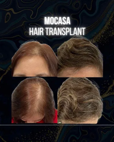 Hair Transplant hair transplant result in Miami