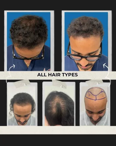 Hair Transplant hair transplant result in Miami