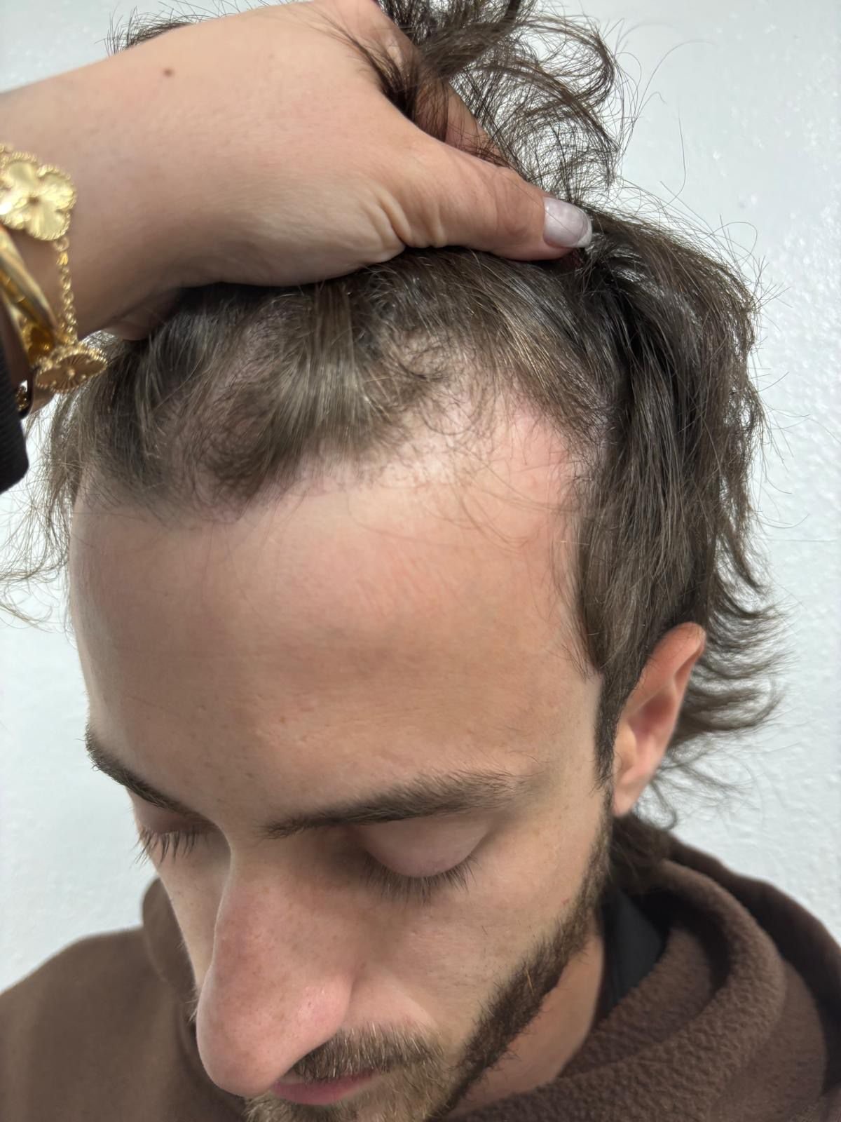 Paso 1 • Evaluación del área frontal — Revisión de densidad y retroceso en las entradas antes del implante FUE.