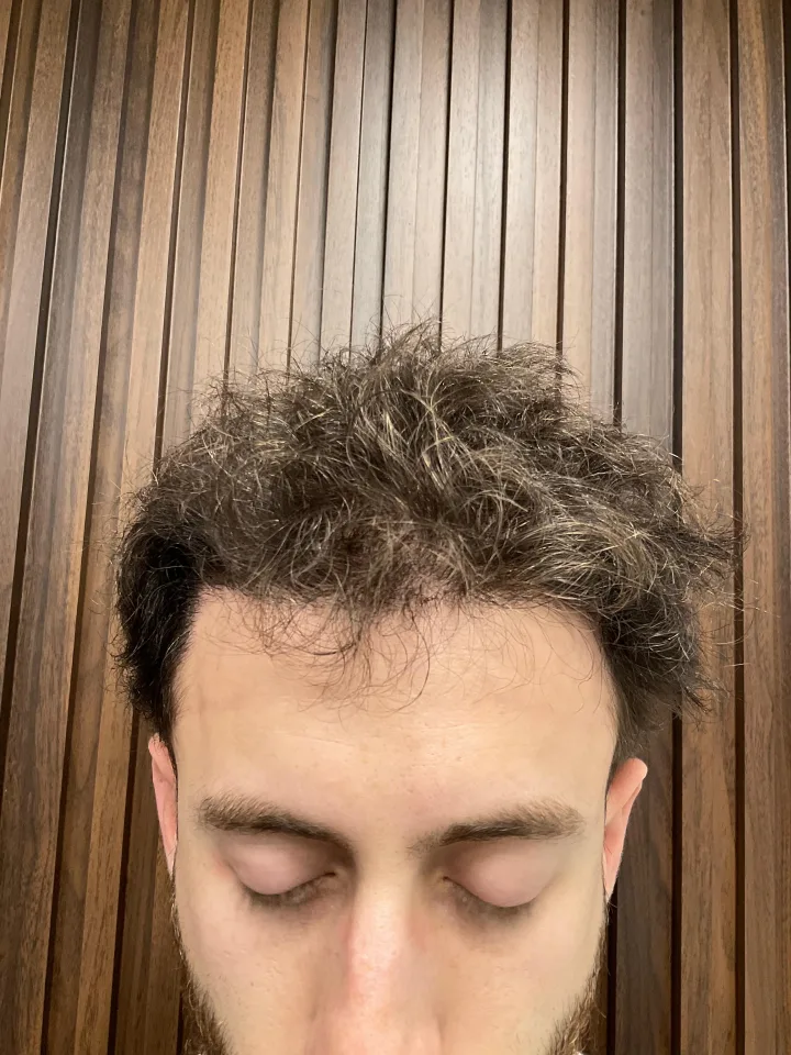 Paso 3 • Resultado en crecimiento — Cobertura y densidad visibles tras el procedimiento de Mocasa Hair Transplant.
