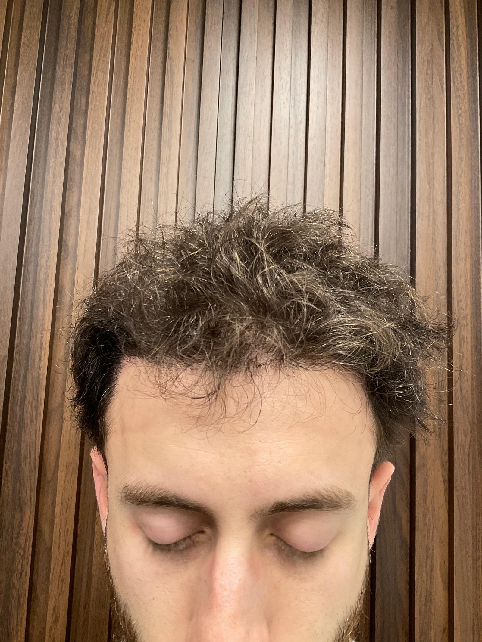 Paso 3 • Resultado en crecimiento — Cobertura y densidad visibles tras el procedimiento de Mocasa Hair Transplant.