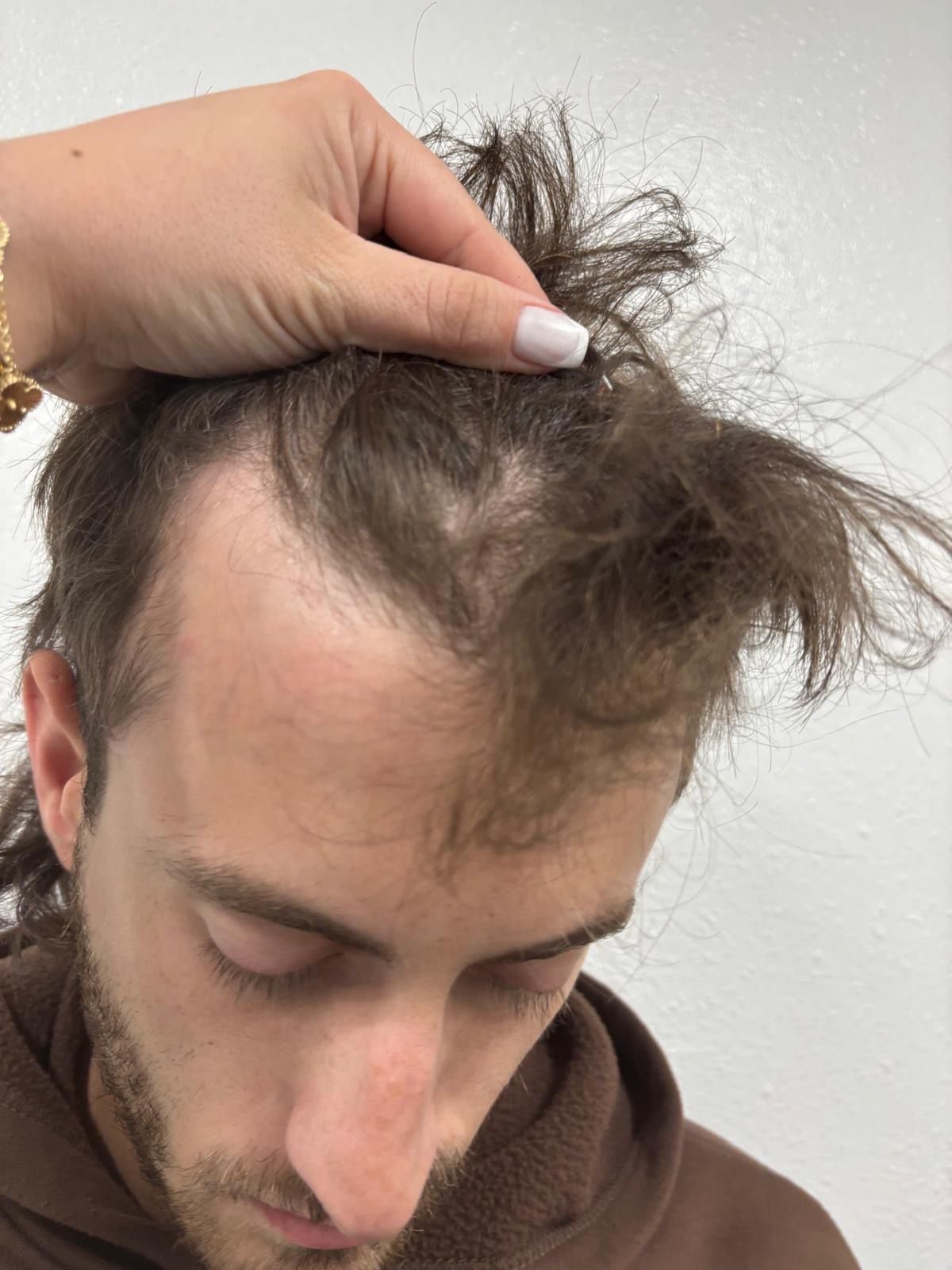 Paso 2 • Diseño de línea frontal — Marcación del patrón a recuperar y planificación de injertos.