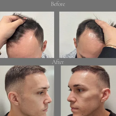 Natural Density Result hair transplant result in Miami